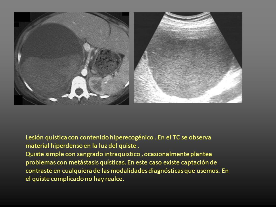 Quiste hepatico simple complicado